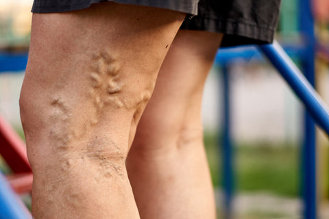 treating varicose veins