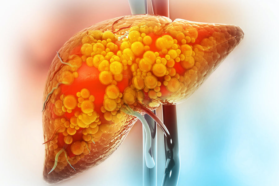 What Is Fatty Liver Disease and How Can You Prevent It?