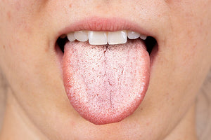 White Tongue Scum