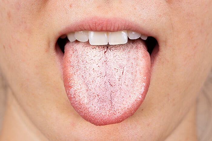 Should White Tongue “Scum” Worry You?
